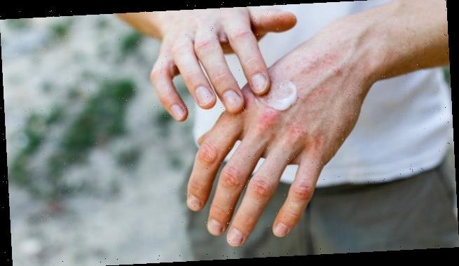 Welche Basispflege bei Neurodermitis können Apotheker empfehlen?